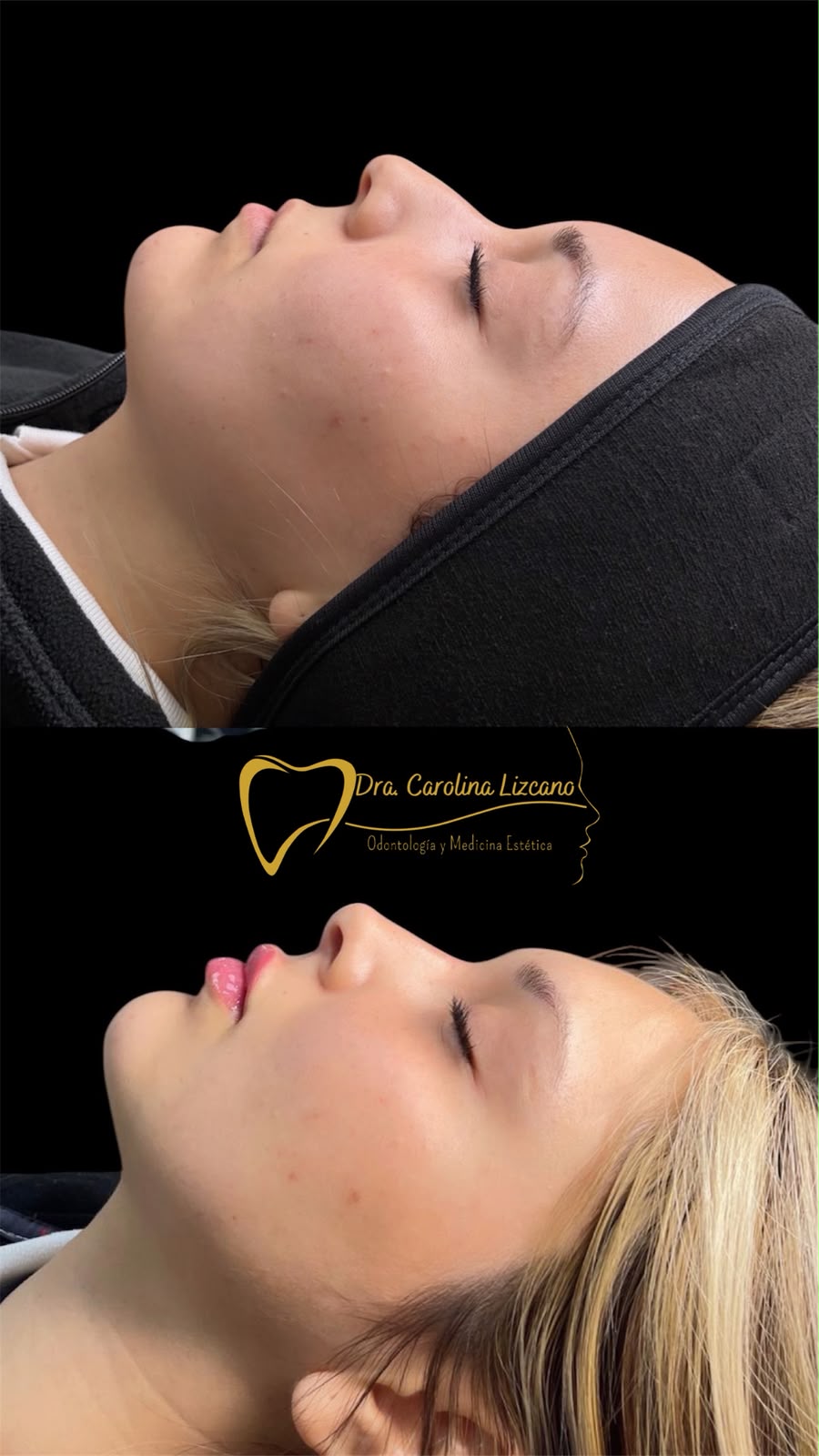 Resultado real de armonización facial, antes y después