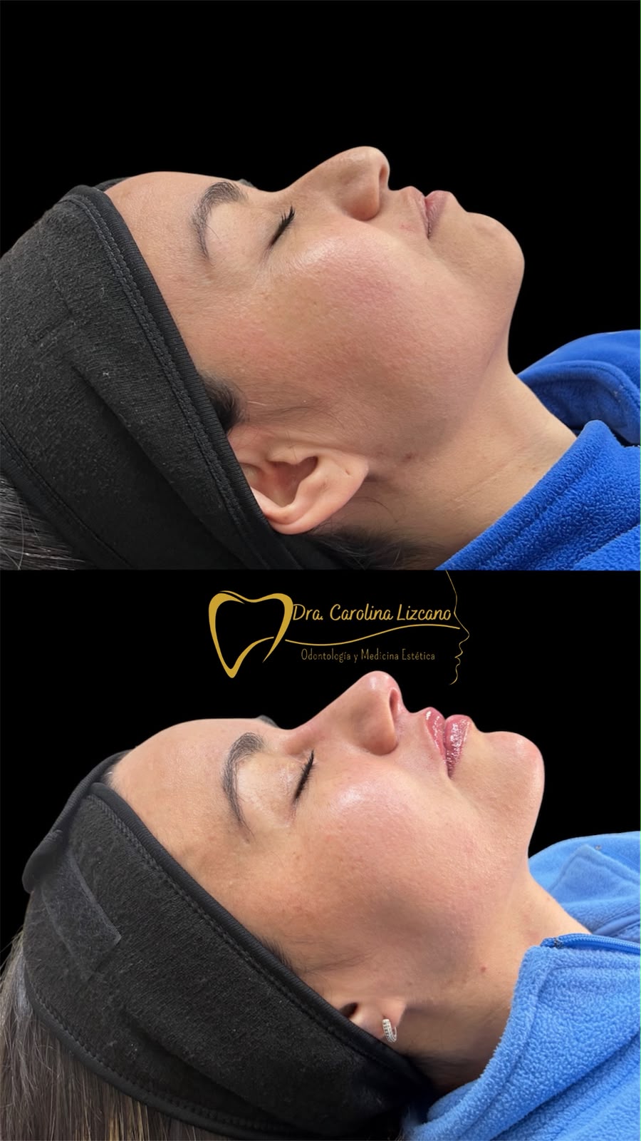 Resultado real de perfilado de labios, antes y después