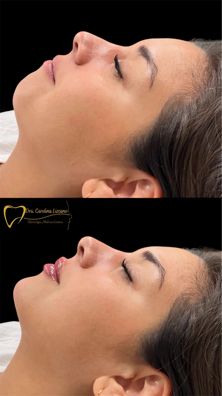 Antes y después de rejuvenecimiento facial con bioestimuladores en Los Andes